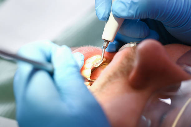 Best Emergency Root Canal Treatment in Rossville, IN